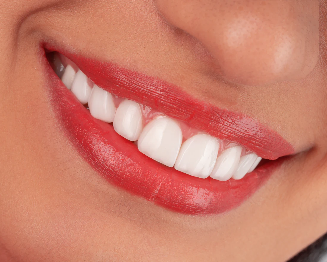 Sorriso depois do clareamento