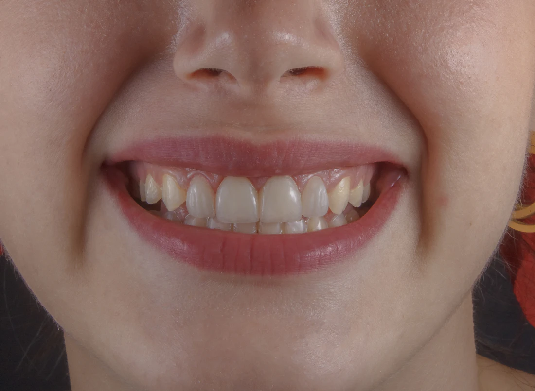 Sorriso em close sendo escaneado